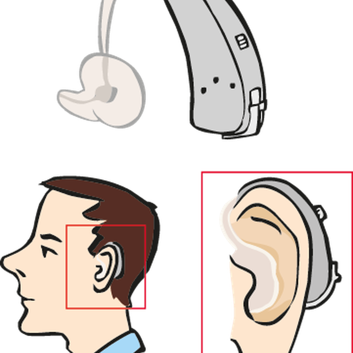 Hörgerät (vergrößerte Bildansicht wird geöffnet)