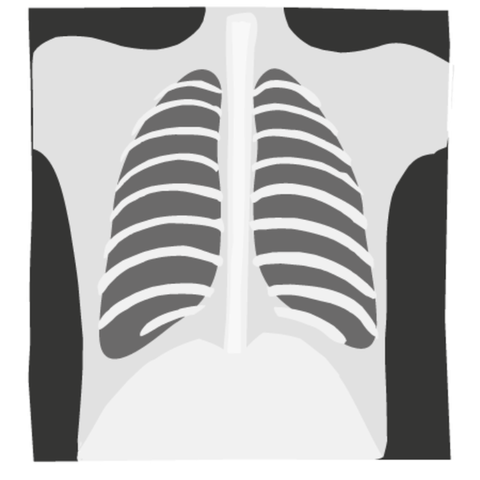 Röntgenbild Lunge (vergrößerte Bildansicht wird geöffnet)