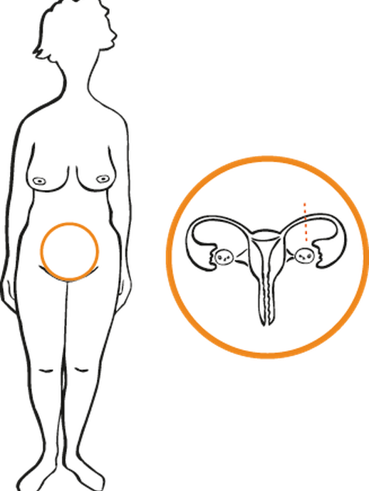 Sterilisation Frau (öffnet vergrößerte Bildansicht)