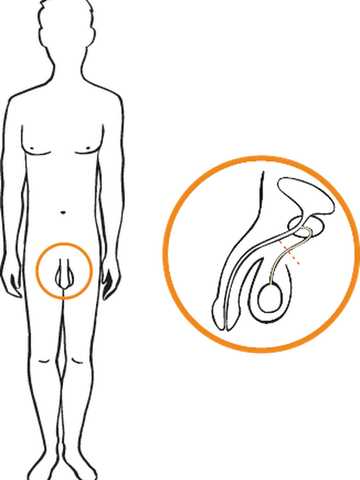 Sterilisation Mann (öffnet vergrößerte Bildansicht)